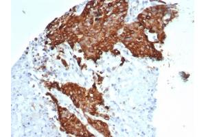 Formalin-fixed, paraffin-embedded human ovarian carcinoma stained with Tubulin beta 3 Recombinant Rabbit Monoclonal Antibody (TUBB3/7089R).