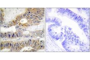 Immunohistochemistry analysis of paraffin-embedded human colon carcinoma tissue, using TNFRSF6B Antibody. (TNFRSF6B 抗体  (AA 251-300))