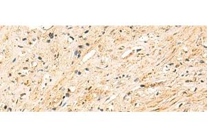 Immunohistochemistry of paraffin-embedded Human prost at e cancer tissue using EEF1AKMT2 Polyclonal Antibody at dilution of 1:50(x200) (METTL10 抗体)
