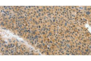 Immunohistochemistry of paraffin-embedded Human liver cancer tissue using ACLY Polyclonal Antibody at dilution 1:40 (ACLY 抗体)