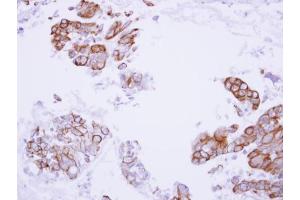 IHC-P Image Immunohistochemical analysis of paraffin-embedded human lung adenocarcinoma, using MASPIN, antibody at 1:100 dilution. (SERPINB5 抗体  (Center))