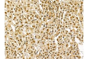 NRF1 Mouse Monoclonal Antibody at 1/100 staining human gastric cancer by IHC-P. (NRF1 抗体  (Internal Region))