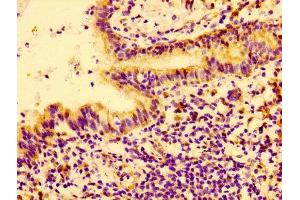 Immunohistochemistry of paraffin-embedded human lung cancer using ABIN7148441 at dilution of 1:100 (CTGF 抗体  (AA 253-349))