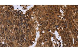 Immunohistochemistry of paraffin-embedded Human cervical cancer using FGFRL1 Polyclonal Antibody at dilution of 1:40 (FGFRL1 抗体)