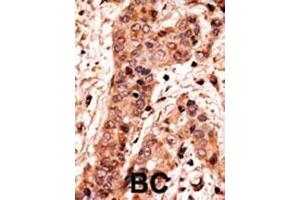 Formalin-fixed and paraffin-embedded human cancer tissue reacted with the primary antibody, which was peroxidase-conjugated to the secondary antibody, followed by AEC staining. (GUCY1A2 抗体  (C-Term))