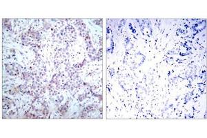 Immunohistochemical analysis of paraffin-embedded human breast carcinoma tissue using NF-κB p65 (Ab-536) antibody (E021014). (NF-kB p65 抗体)