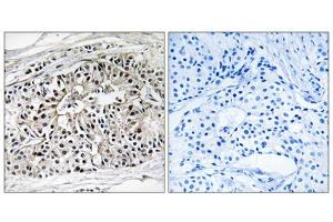 Immunohistochemistry analysis of paraffin-embedded human breast carcinoma tissue using EHHADH antibody. (EHHADH 抗体  (Internal Region))