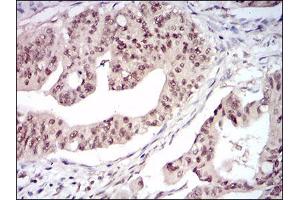Immunohistochemical analysis of paraffin-embedded rectum cancer tissues using DNMT1 mouse mAb with DAB staining. (DNMT1 抗体  (AA 1448-1594))