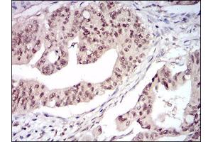 Immunohistochemical analysis of paraffin-embedded rectum cancer tissues using DNMT1 mouse mAb with DAB staining.