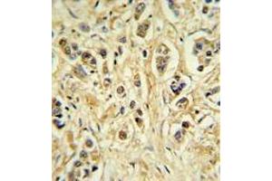 ZNF202 Antibody (Center) IHC analysis in formalin fixed and paraffin embedded breast carcinoma followed by peroxidase conjugation of the secondary antibody and DAB staining. (ZNF202 抗体  (Middle Region))