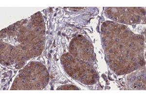 ABIN6277805 at 1/100 staining Human liver cancer tissue by IHC-P. (NCR1 抗体  (Internal Region))