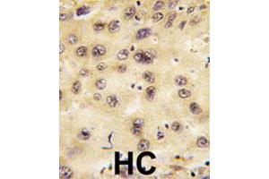 Formalin-fixed and paraffin-embedded human hepatocellular carcinoma tissue reacted with PROX1 polyclonal antibody , which was peroxidase-conjugated to the secondary antibody, followed by DAB staining. (PROX1 抗体  (Internal Region))
