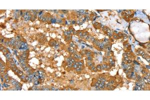 Immunohistochemistry of paraffin-embedded Human thyroid cancer using PYGL Polyclonal Antibody at dilution of 1:35 (PYGL 抗体)