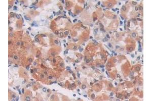 Detection of S100A5 in Human Stomach cancer Tissue using Monoclonal Antibody to S100 Calcium Binding Protein A5 (S100A5) (S100A5 抗体  (AA 1-92))