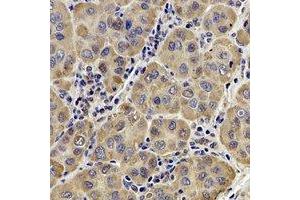 Immunohistochemical analysis of AP1-mu-2 staining in human liver cancer formalin fixed paraffin embedded tissue section.