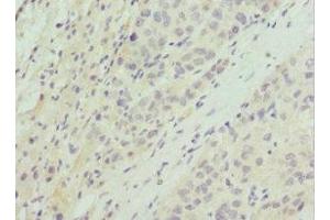 Immunohistochemistry of paraffin-embedded human liver cancer using ABIN7164754 at dilution of 1:100 (PRAS40 抗体  (AA 132-256))