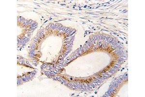 IHC analysis of FFPE human colon carcinoma tissue stained with GDF11 antibody (GDF11 抗体  (AA 32-61))