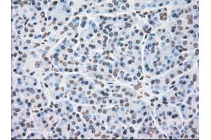 Immunohistochemical staining of paraffin-embedded Adenocarcinoma of colon tissue using anti-PLK1mouse monoclonal antibody. (PLK1 抗体)