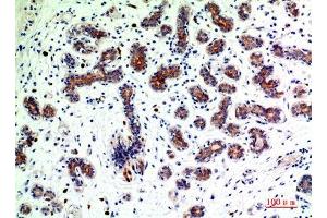 Immunohistochemical analysis of paraffin-embedded human-breast-cancer, antibody was diluted at 1:200 (BMP2 抗体  (C-Term))
