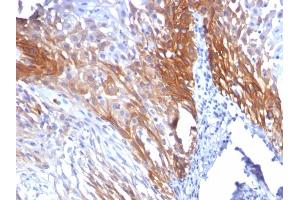 Formalin-fixed, paraffin-embedded human Cervical Carcinoma stained with CK17 Mouse Monoclonal Antibody (KRT17/778). (KRT17 抗体)