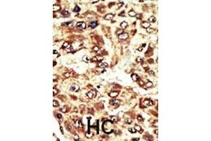 Formalin-fixed and paraffin-embedded human cancer tissue reacted with the primary antibody, which was peroxidase-conjugated to the secondary antibody, followed by AEC staining. (WEE1 抗体  (C-Term))