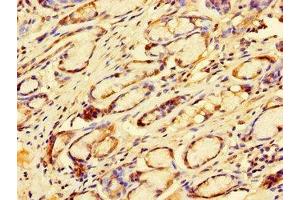 Immunohistochemistry of paraffin-embedded human gastric cancer using ABIN7172505 at dilution of 1:100 (DP2 抗体  (AA 344-386))