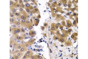 Immunohistochemistry of paraffin-embedded Human liver cancer using SCP2 Polyclonal Antibody at dilution of 1:200 (40x lens). (SCP2 抗体)
