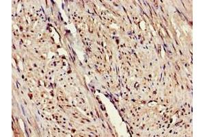 Immunohistochemistry of paraffin-embedded human endometrial cancer using ABIN7151655 at dilution of 1:100 (ERAP1 抗体  (AA 642-941))
