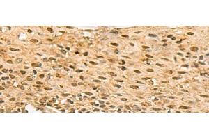 Immunohistochemistry of paraffin-embedded Human cervical cancer tissue using SCMH1 Polyclonal Antibody at dilution of 1:120(x200) (SCMH1 抗体)