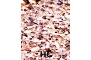 Formalin-fixed and paraffin-embedded human hepatocellular carcinoma tissue reacted with CREB1 (phospho S133) polyclonal antibody  which was peroxidase-conjugated to the secondary antibody followed by AEC staining.