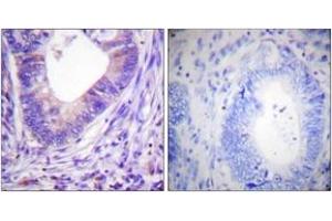 Immunohistochemistry analysis of paraffin-embedded human colon carcinoma tissue, using PKA alpha/beta CAT (Ab-197) Antibody. (PKA alpha/beta Cat (AA 166-215) 抗体)