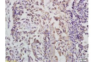 Formalin-fixed and paraffin embedded human colon carcinoma labeled with Anti-Phospho-FoxO3a (Ser253) Polyclonal Antibody, Unconjugated (ABIN684718) at 1:200 followed by conjugation to the secondary antibody