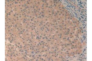 IHC-P analysis of Human Liver Cancer Tissue, with DAB staining. (RELB 抗体  (AA 248-492))