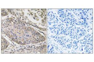 Immunohistochemistry analysis of paraffin-embedded human lung carcinoma tissue using PLA2G4E antibody. (PLA2G4E 抗体  (Internal Region))
