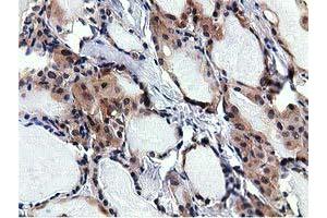 Immunohistochemical staining of paraffin-embedded Carcinoma of Human thyroid tissue using anti-RBBP9 mouse monoclonal antibody. (RBBP9 抗体)