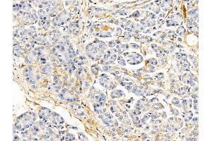 ABIN6260508 and ABIN6268919 at 1/100 staining Human pancreatic cancer and adjacent nomal tissues by IHC-P. (Caveolin-1 抗体  (C-Term))