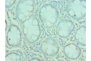 Immunohistochemistry of paraffin-embedded human colon cancer using ABIN7167157 at dilution of 1:100 (G3BP1 抗体  (AA 227-466))