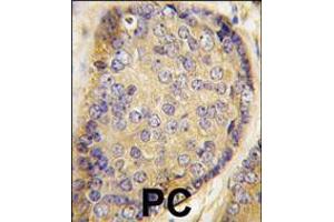 Formalin-fixed and paraffin-embedded human prostata carcinoma tissue reacted with Latexin antibody , which was peroxidase-conjugated to the secondary antibody, followed by DAB staining. (Latexin 抗体  (AA 78-107))