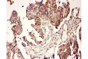 IHC-P: CNTF antibody testing of human intestine cancer tissue (CNTF 抗体  (AA 2-200))