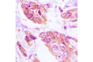 Immunohistochemical analysis of HSPH1 staining in human lung cancer formalin fixed paraffin embedded tissue section. (HSPH1 抗体  (C-Term))