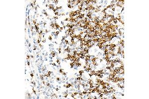 Immunohistochemistry of paraffin-embedded Human Hodgkin lymphoma using IGHD antibody (ABIN7267824) at dilution of 1:100 (40x lens). (IgD 抗体)