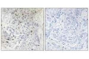 Immunohistochemistry analysis of paraffin-embedded human breast carcinoma tissue, using MAFF antibody. (MafF 抗体)