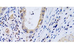 Immunohistochemistry of paraffin-embedded Human gastric cancer using PTGIR Polyclonal Antibody at dilution of 1:200 (40x lens). (Prostacyclin Receptor 抗体)