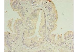 Immunohistochemistry of paraffin-embedded human prostate cancer using ABIN7166819 at dilution of 1:100 (C11ORF45 抗体  (AA 23-145))