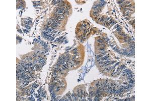 Immunohistochemistry of Human colon cancer using PGK1 Polyclonal Antibody at dilution of 1:50 (PGK1 抗体)