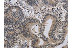 The image on the left is immunohistochemistry of paraffin-embedded Human colon cancer tissue using ABIN7189784(ALX4 Antibody) at dilution 1/20, on the right is treated with synthetic peptide. (ALX4 抗体)