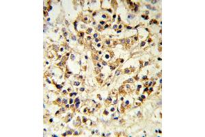 FGFR1 Antibody i IHC analysis in formalin fixed and paraffin embedded human breast carcinoma followed by peroxidase conjugation of the secondary antibody and DAB staining. (FGFR1 抗体)