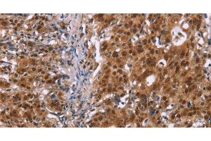 Immunohistochemistry of paraffin-embedded Human gastic cancer using CBX3 Polyclonal Antibody at dilution of 1:40 (CBX3 抗体)