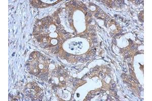 IHC-P Image Immunohistochemical analysis of paraffin-embedded human gastric cancer, using GPX2, antibody at 1:500 dilution. (Glutathione Peroxidase 2 抗体  (C-Term))