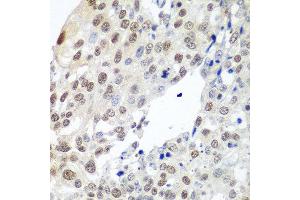 Immunohistochemistry of paraffin-embedded human lung cancer using PTTG1 antibody at dilution of 1:100 (40x lens). (PTTG1 抗体)